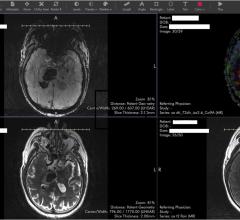 Stroke imaging using Ambra health’s in built viewer.