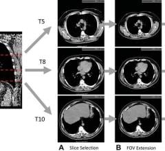 Artificial intelligence (AI) can use data from low-dose CT scans of the lungs to improve risk prediction for death from lung cancer, cardiovascular disease and other causes 