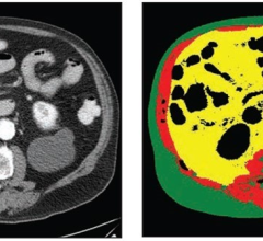 70-year-old White male patient with weight of 79.8 kg, BMI of 29.3, low cardiovascular risk factors (nonsmoker, no diabetes diagnosis, blood pressure of 120/78). Left: Axial CT image at level of L3 vertebral body. Right: Matching automated segmentation label map. Visceral fat area z score is 1.41, corresponding to the 92nd percentile. Patient experienced both subsequent myocardial infarction and stroke. 