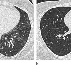 Bariatric surgery and weight loss appear to reverse some of the negative effects of obesity on the respiratory system, according to a study published in the journal Radiology