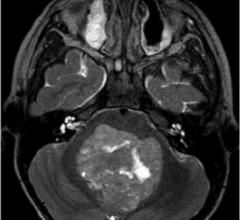 brain metastases, stereotactic radiosurgery, SRS, local recurrence, ASTRO 2016 study