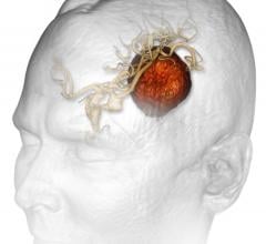 low-grade brain tumors, gliomas, UC San Diego, survival rates up, adults