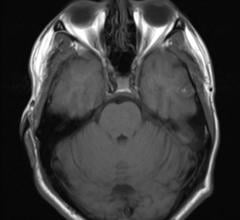 MRI, brain scans, shrinkage, dementia with Lewy bodies, Alzheimer's disease, Neurology journal study