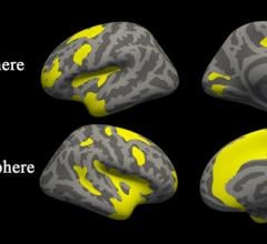 MRI Uncovers Brain Abnormalities in People With Depression and Anxiety