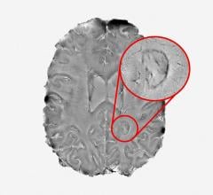 Smoldering Spots in the Brain May Signal Severe MS