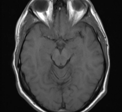 Oxford University Research Brain MRI Resting-state fMRI Parkinson's