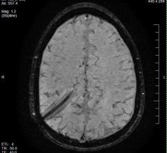 Researchers Identify Visual System Changes that May Signal Parkinson's Disease