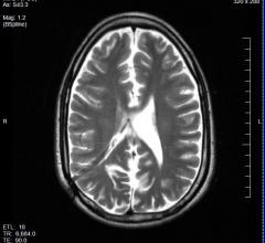 multiple sclerosis, MS, T2-weighted MRI, University of Nottingham study