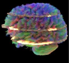 insomnia, white matter, MRI, diffusion tensor imaging, DTI, neuro imaging study, Radiology journal
