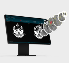  AI Technology Helps Reveal Efficacy of Neuroprotective Drug Candidate in Severe Acute Ischemic Stroke Patients