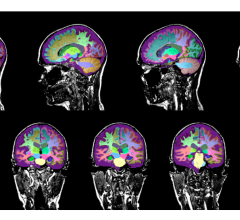 Neuroreader Report analyzes an MRI sequence to determine whether brain structures are abnormal and to what extent. It visualizes and quantifies 45 individual brain structures in less than ten minutes after Magnetic Resonance Imaging