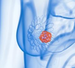 Targeted Radioimmunotherapy Regimen Achieves Complete, Durable Response in Breast Cancer Model