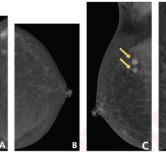 48-year-old woman who underwent CEM to evaluate two masses (arrows) in right breast. CEM obtained in following order: (A) craniocaudal (CC) view of right breast; (B) CC view of left breast; (C) mediolateral oblique (MLO) view of right breast; and (D) MLO view of left breast. Degree of background parenchymal enhancement (BPE) increases over time after contrast agent injection. (A) CC view of right breast shows mild BPE, whereas subsequently obtained (B) CC view of left breast shows moderate BPE. 