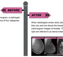 When radiologists review mammograms, they can see how dense the breasts are. Below are four mammogram images of breasts. The two images on the right are referred to as dense breasts. 