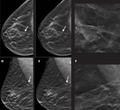 Images in a 55-year-old woman with a spiculated mass localized in the upper central quadrant (arrow in A, B, D, and E) of right breast detected with digital breast tomosynthesis (DBT) plus synthetic mammography (SM). Breast density was classified as category C with the Breast Imaging Reporting and Data System. Mass was invasive ductal carcinoma, stage I, and was estrogen and progesterone receptor positive and human epidermal growth factor receptor 2 negative. A, Image from SM in craniocaudal view. B, Single