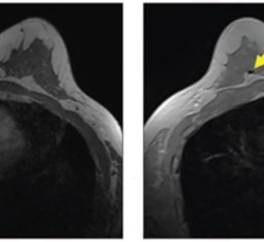 57-year-old patient with breast biopsy clips who underwent breast MRI for high-risk screening. A. Axial T1-weighted non-fat-saturated MR image shows no area of signal void. No reader detected clip using this sequence. B. Axial contrast-enhanced in-phase Dixon image shows signal void in right breast (arrow), which corresponded with MammoMark/CorMark Bread Tie biopsy clip. All three readers detected clip on this sequence, with confidence scores of 4, 3, and 2; assessments all classified as true positives (i.e