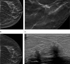 DBT, sometimes called 3-D mammography, emerged in the last decade as a powerful tool for breast cancer screening