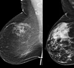 automated volumetric breast density, Elizabeth Wende Breast Care, EWBC, American Journal of Roentgenology, mammographic sensitivity