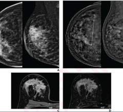 41-year-old woman with invasive ductal carcinoma (G2, luminal B) of right breast