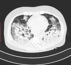 Transverse view of as lung CT showing heavy areas of COVID pneumonia in the lungs