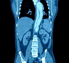 CT, computed tomography, IV contrast media, acute kidney injury risk, Annals of Emergency Medicine study