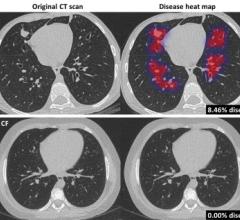 Thirona, an artificial intelligence (AI) software company specialising in medical image analysis, developed an AI algorithm that revolutionizes cystic fibrosis (CF) care. The new algorithm, coined PRAGMA-AI, allows for fast, automated analysis of CT scans of patients with CF to detect and quantify lung abnormalities related to CF