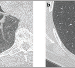 58-Year-Old Woman With Right Lower Lobe Nodule: (a) Present lung cancer screening CT and (b) lung cancer screening CT performed 2 years prior. Nodule described as growing pure ground-glass nodule (associated with cystic lesion), measuring 15 mm in mean diameter. Nodule categorized Lung-RADS 3 by clinical report, though Lung-RADS 2 by strict application of size criteria. Subsequent wedge resection demonstrated lepidic-predominant adenocarcinoma.