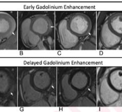 T1-Based Criteria for Myocarditis on Cardiac MRI in Patients With Recent COVID-19 mRNA Vaccination: Early gadolinium enhancement (EGE) compared with precontrast SSFP sequence (not shown) is observed on early postcontrast short-axis SSFP images in (A) 16-year-old male, (B) 17-year-old male, (C) 16-year-old male, and (D) 19-year-old male, and on early postcontrast short-axis perfusion image in (E) 17-year-old male (arrow, A-E). Late gadolinium enhancement (LGE) is also present (arrows) in all 5 patients (F, G