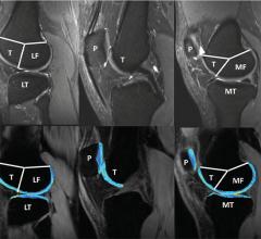 New recommendations will help provide more reliable, reproducible results for MRI-based measurements of cartilage degeneration in the knee, helping to slow down disease and prevent progression to irreversible osteoarthritis, according to a special report published in the journal Radiology