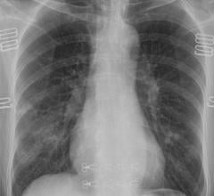 Chest radiograph in a patient with COVID-19 infection demonstrates right infrahilar airspace opacities #COVID19 #Coronavirus #2019nCoV #Wuhanvirus #HIMSS20