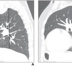 62-Year-Old Woman Who Underwent Hysterectomy for Uterine Cancer: Sagittal chest CT images demonstrate measurement of right (A) and left (B) lung length at hilar level from apex to diaphragmatic dome. Right lung length was 20.1 cm for reader 1 and 20.0 cm for reader 2; left lung length was 21.7 cm for reader 1 and 21.3 cm for reader 2. Patient did not require postoperative mechanical ventilation.
