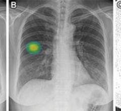 Using a single chest X-ray, a new AI tool can identify non-smokers who are at high risk for lung cancer
