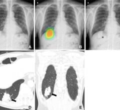Assistance from an artificial intelligence (AI) algorithm with high diagnostic accuracy improved radiologist performance in detecting lung cancers on chest X-rays and increased human acceptance of AI suggestions, according to a study published in Radiology, a journal of the Radiological Society of North America (RSNA). 