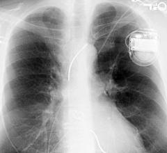 Artificial Intelligence Can Improve Emergency X-ray Identification of Pacemakers