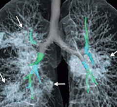 Images in a 41-year-old woman who presented with fever and positive polymerase chain reaction assay for the 2019 novel coronavirus (2019-nCoV) #coronavirus #nCoV2019 #2019nCoV #COVID19 