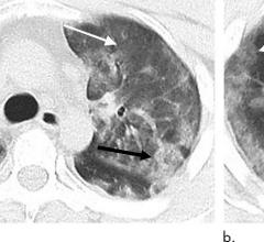  over the course of a week and a half #coronavirus #COVID19 #COVID-2019 #2019nCoV
