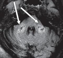 Axial FLAIR MR image shows T2 prolongation in bilateral middle cerebellar peduncles (arrows). Findings were associated with restricted diffusion and areas of T1 hypointense signal without enhancement or abnormal susceptibility. Image courtesy of American Roentgen Ray Society (ARRS), American Journal of Roentgenology (AJR)