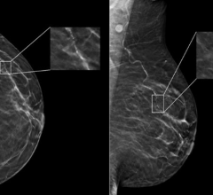 According to a newly-published study of nearly 5,000 screening mammograms interpreted by an FDA-approved AI algorithm, patient characteristics such as race and age influenced false positive results. 
