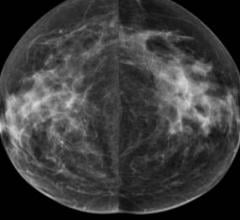 New Study Highlights Breakthrough Therapy to Reduce Mammographic Breast Density
