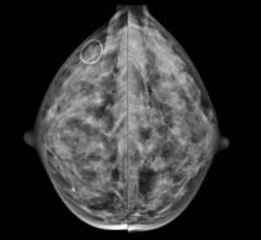 dense breast tissue, contralateral breast cancer, MD Anderson study, Cancer journal