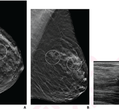 for patients with multiple architectural distortion (AD) identified on digital breast tomosynthesis (DBT), biopsy of all areas may be warranted, given the variation of pathologic diagnoses across AD in individual patients 