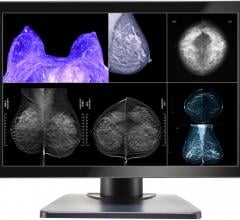 Double Black Announces Gemini Series Monitors for Multimodality and Digital Breast Imaging