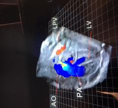 EchoPixel Showcases Next-Generation Surgical Planning With True 3-D Interactive Mixed Reality Software