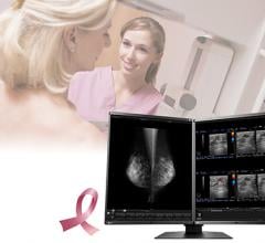 Eizo RadiForce RX560 Monitor Receives FDA 510(k) for Tomosynthesis and Digital Mammography