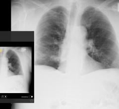  Emergent Connect pneumothorax image