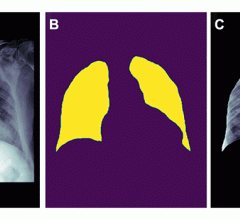 Example of how improper feature removal from imaging data may lead to bias. (A) Chest radiograph in a male patient with pneumonia. (B) Segmentation mask for the lung, generated using a deep learning model. (C) Chest radiograph is cropped based on the segmentation mask. If the cropped chest radiograph is fed to a subsequent classifier for detecting consolidations, the consolidation that is located behind the heart will be missed (arrow, A). This occurs because primary feature removal using the segmentation m