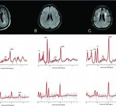 1H-MR spectra of 3 consecutive patients with COVID-19. Upper row: Axial FLAIR images at the corona radiata level show representative MRS voxels (black squares) from sampled periventricular regions. Lower row: Corresponding spectrum (black) and LCModel fit (red) from each patient acquired at TE = 30 ms (upper row) and TE = 288 ms (lower row). A, A patient with COVID-19-associated multifocal necrotizing leukoencephalopathy shows diffuse patchy WM lesions with markedly increased Cho and decreased NAA, as well 