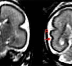 Figure 1. Left: Fetal brain post-intrauterine alcohol exposure in fetus between 25 and 29 gestational weeks. Note the smooth cortex in frontoparietal and temporal lobes. Right: Brain of matched healthy control case in fetus between 25 and 28 gestational weeks. The superior temporal sulcus is already bilaterally formed (red arrows) and appears deeper on the right hemisphere than on the left.