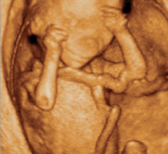  3D ultrasound