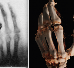 Left, the first X-ray ever made of Roentgen's wife's hand in 1895. Right, a cone-beam CT 3-D reconstruction of a hand in 2015 using a new robotic digital radiography (DR) X-ray system. 